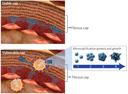 Nature materials: 细胞外膜泡介导动脉粥样硬化斑块中微钙化的发生和发展