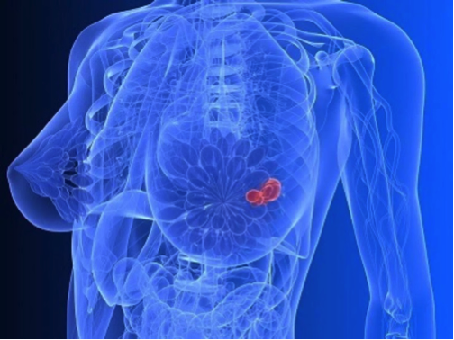 哈佛大学波士顿儿童医院：含miR-200的细胞外膜泡促进乳腺癌的转移