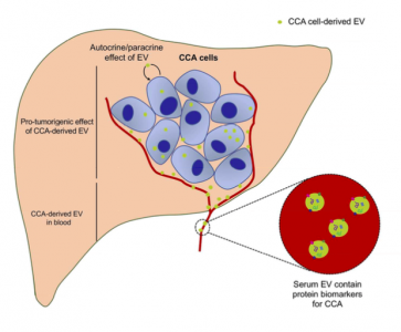 Hepatology：血清外泌体包含原发性硬化性胆管炎和胆管癌的蛋白质生物标志物