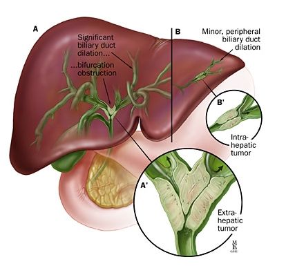 Gastroenterology：胆汁中的细胞外囊泡可作为恶性胆管狭窄的标记物