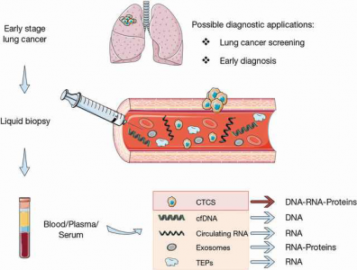 【综述】用于肺癌早期检测的液体活检目前研究现状