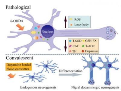 血液外泌体装载多巴胺直达大脑 用于帕金森病的治疗