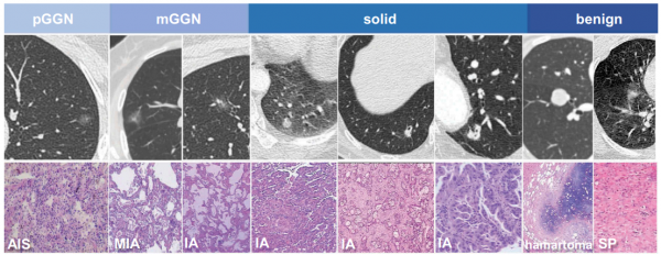 JEV：血浆细胞外囊泡中的miRNA用于肺磨玻璃结节的诊断