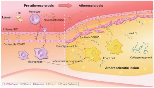 【Theranostics综述】外泌体作为动脉粥样硬化的生物标志物和治疗靶标