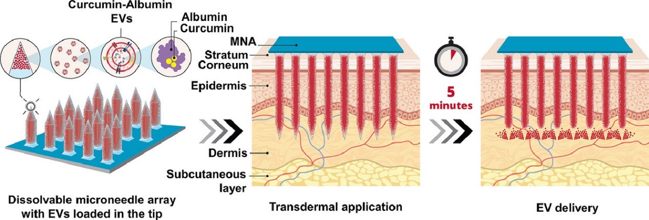 Acta Biomater丨使用可溶性微针阵列递送包裹姜黄素的细胞外囊泡 用于皮肤炎症治疗