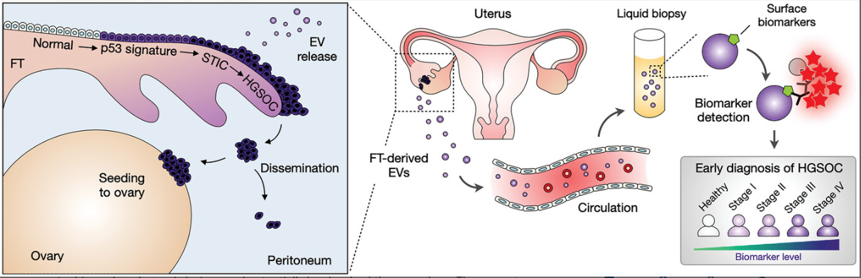 Adv Sci丨细胞外囊泡的高通量分析用于卵巢癌早期检测