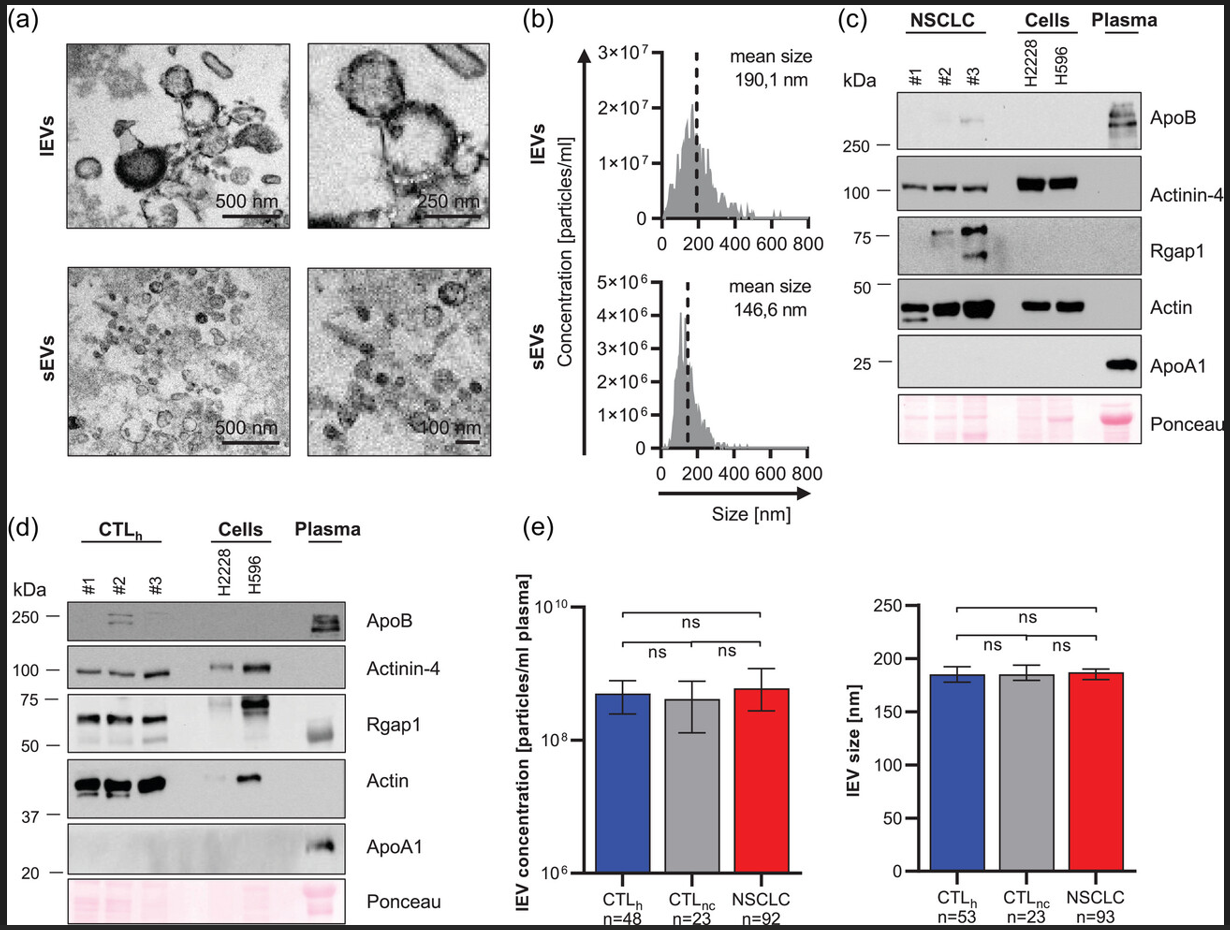 J Extracell Vesicles丨大细胞外囊泡上的PD-L1作为非小细胞肺癌患者免疫治疗反应的预测标志